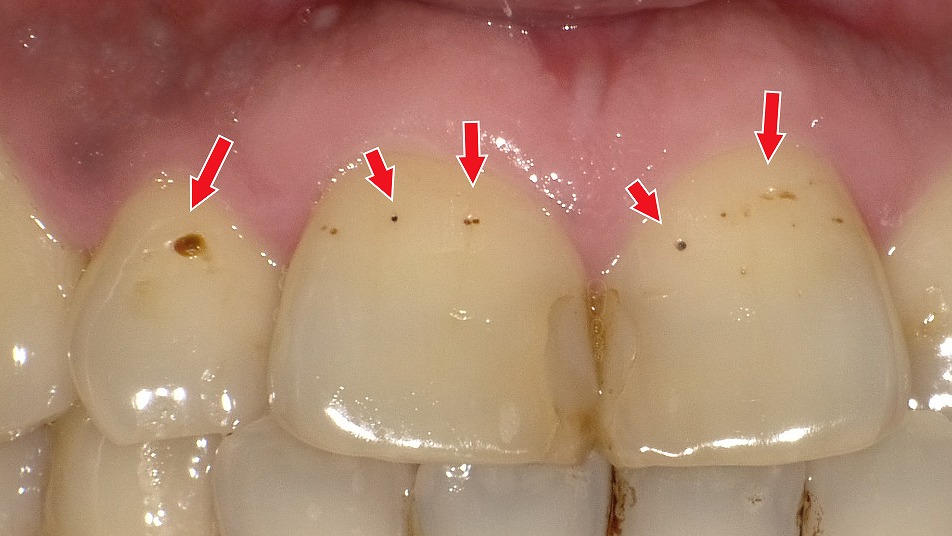 エナメル質表層がわずかに脱灰した初期虫歯(C0)の黒い点