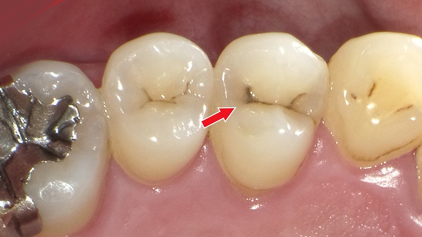 小臼歯の溝に生じた初期虫歯(C0)です。まだ表層がわずかに脱灰している段階で、穴は開いていないため削る必要はありません。