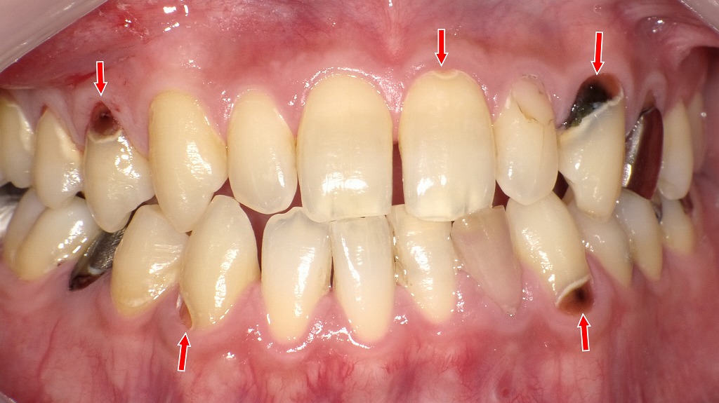 前歯部から臼歯部に広がる多発性の歯頸部う蝕