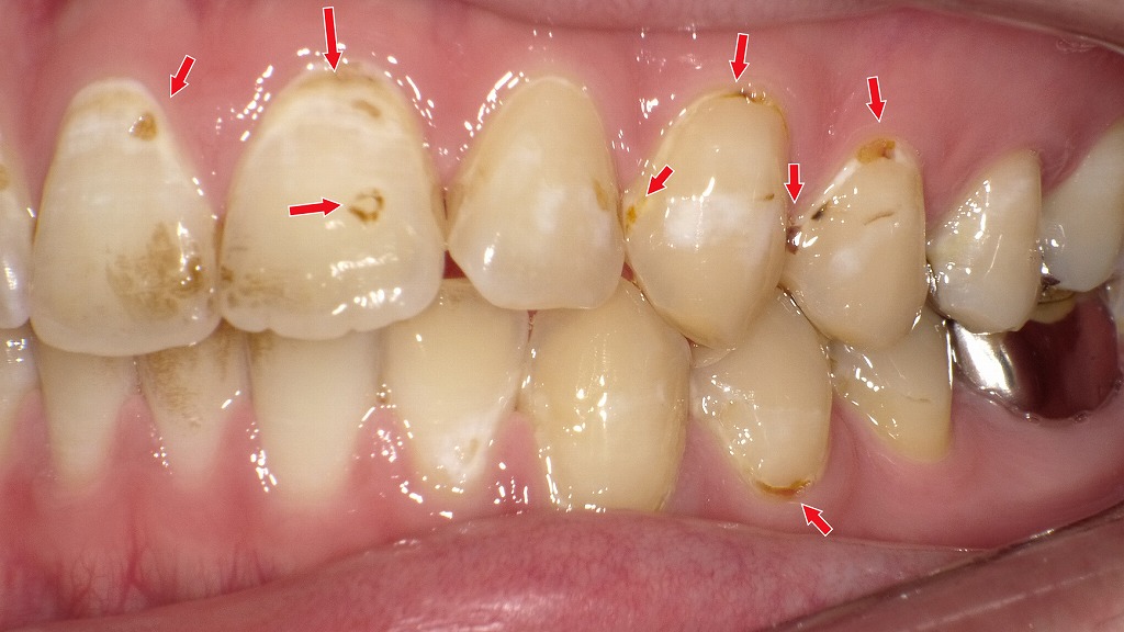 前歯から小臼歯に多発する初期虫歯(C1)|白濁と茶色の変色が示す進行サイン。審美性と虫歯進行の両面から、早めの診断とケアが重要です。