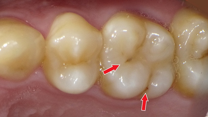 奥歯の溝に入り込んだ着色汚れ(ステイン)