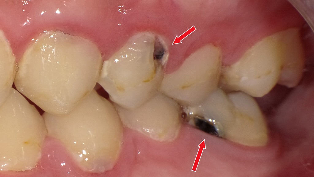 上下にみられる象牙質まで進行した虫歯(C2)|自然治癒が難しく治療が必要な状態