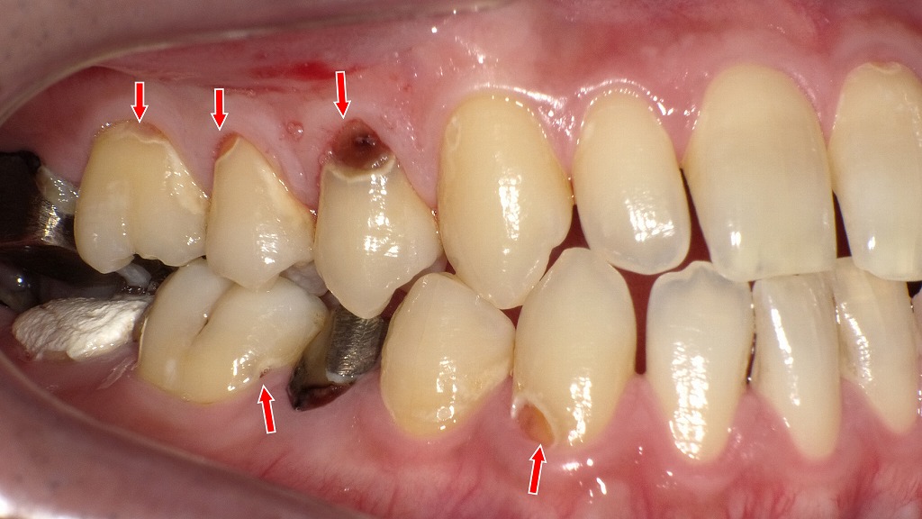 歯頸部う蝕が進行した右側面の状態