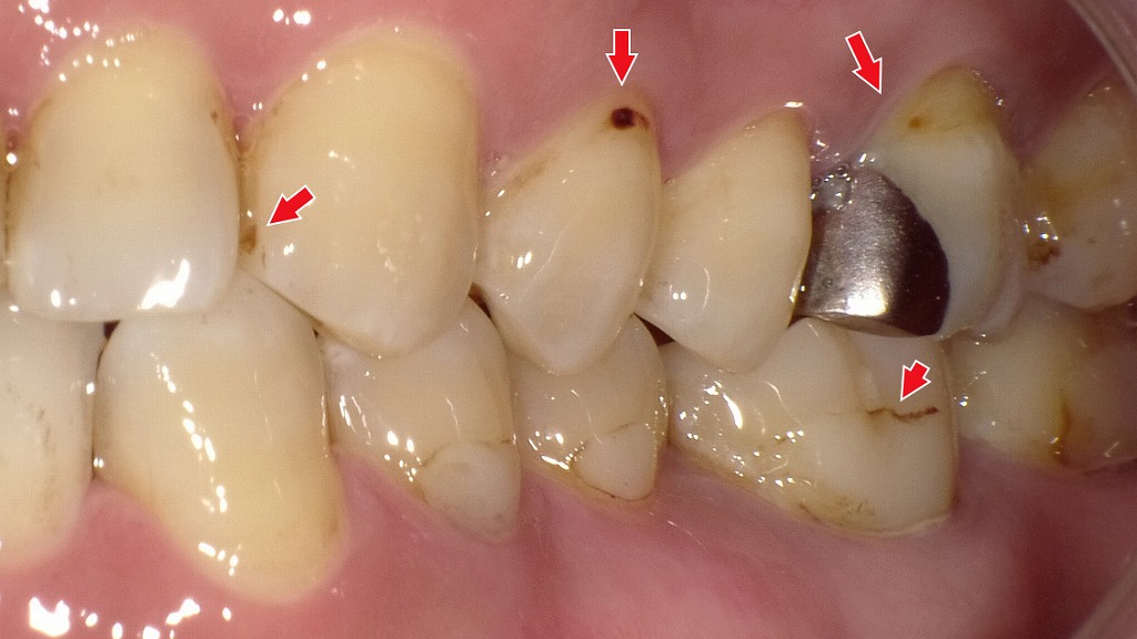 エナメル質表層の初期虫歯(C0)や、コンポジットレジン修復物の辺縁からの着色が混在
