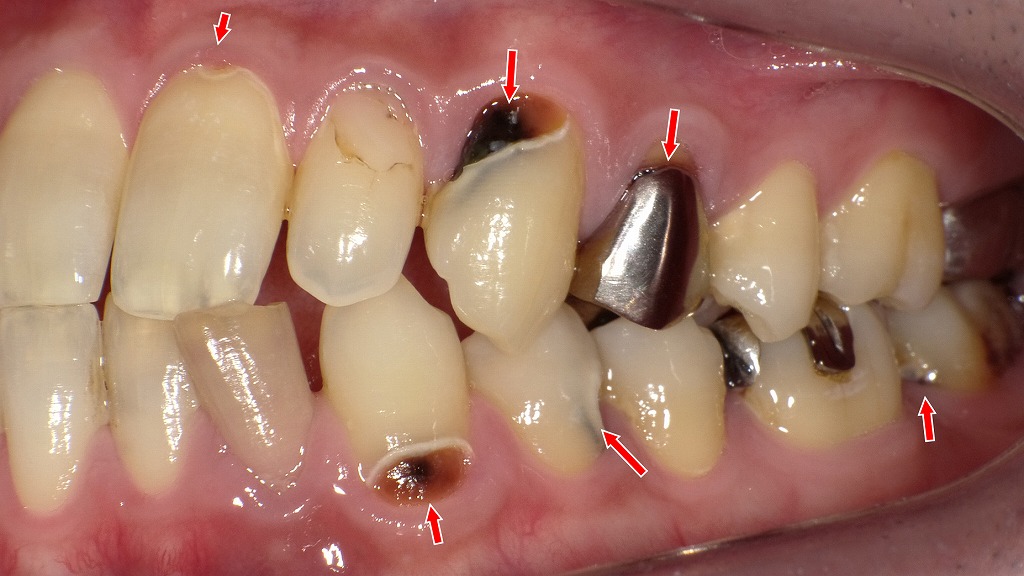 金属修復周囲にも及ぶ重度の歯頸部う蝕
