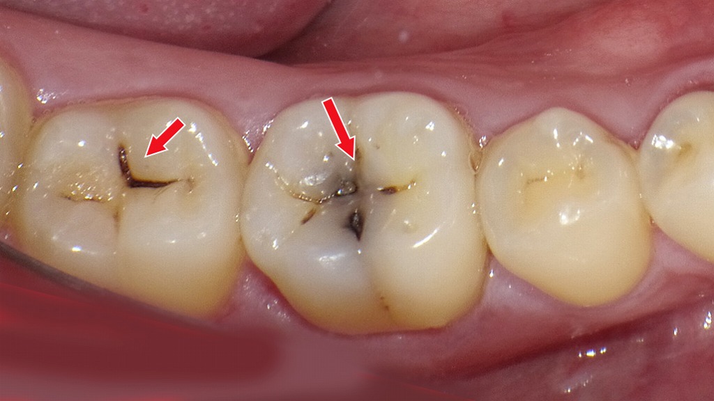 下顎6番は象牙質まで進行した虫歯(C2)|7番は初期虫歯(C1)で進行段階が異なる例