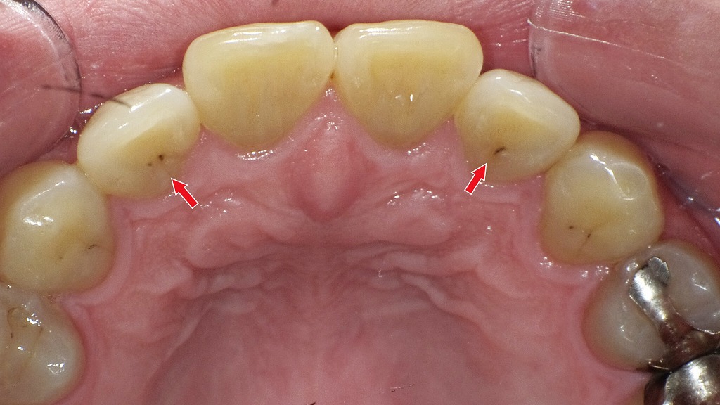 前歯の裏側に見られる着色汚れ(ステイン)