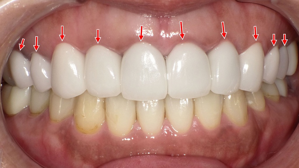 オールセラミッククラウン