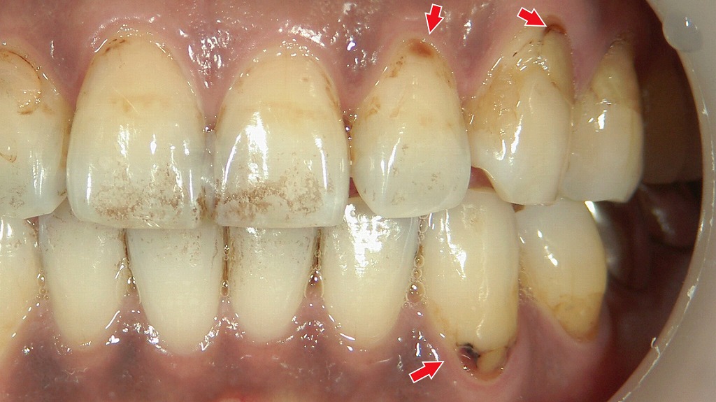前歯に多発する初期虫歯(C1)と下顎の進行リスクの高い虫歯|部位により治療方針が異なるケース