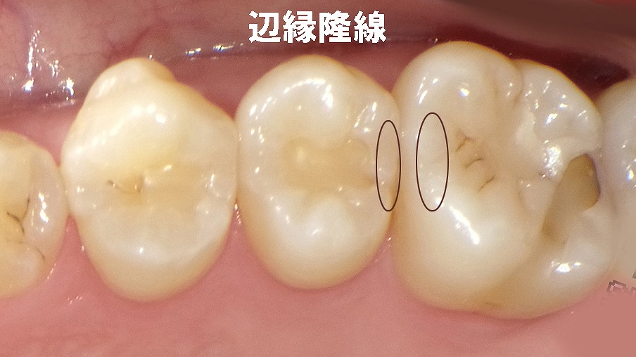 奥歯の“辺縁隆線”とは?噛み合わせを守る大切な壁