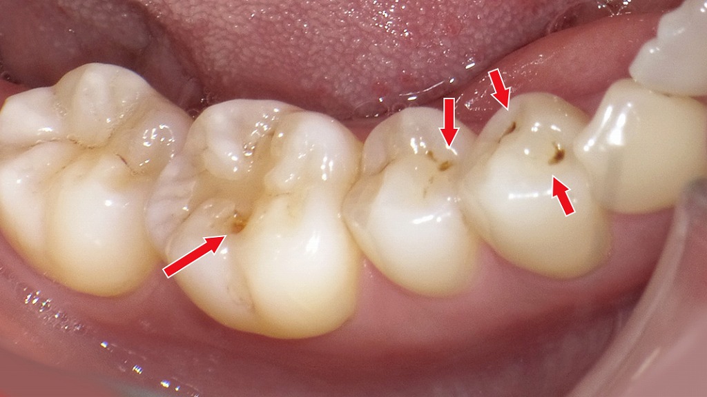 下顎小臼歯・大臼歯の溝にたまった着色汚れ(ステイン)