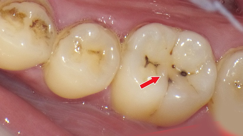 下顎6番の初期虫歯(C1)|咬合面の黒い点は早期管理で削らず治せることも