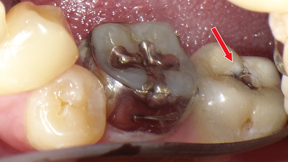 下顎7番の象牙質まで進行した虫歯(C2)|溝から広がるため早期治療が必要