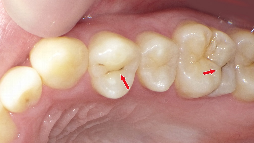 上顎小臼歯・大臼歯の溝に残る着色汚れ(ステイン)
