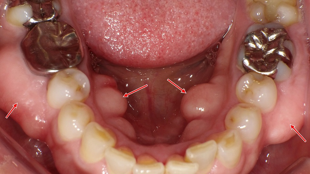 下顎舌側・頬側にみられる外骨症（下顎隆起）