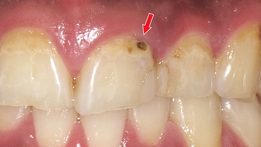 前歯の初期虫歯(C1)|進行は止められても見た目に影響が出やすい段階