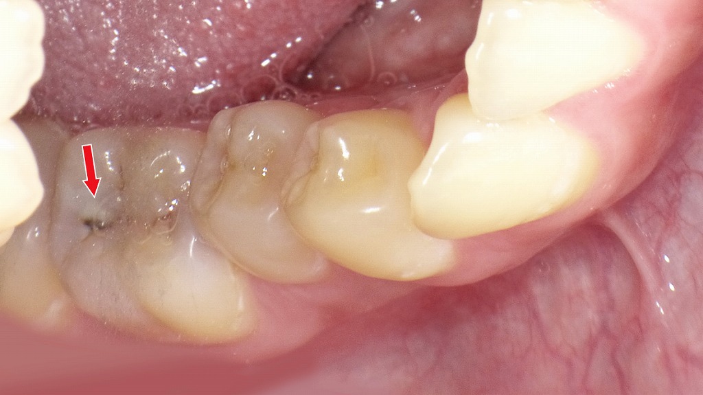 下顎6番の初期虫歯(C1)|溝の黒い点は進行リスクが高く治療が必要なケース