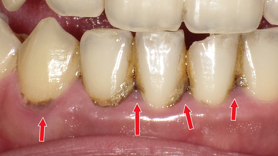 下顎前歯の歯と歯ぐきの境目に黒く硬い歯石(縁下歯石)が広範囲に付着しています。