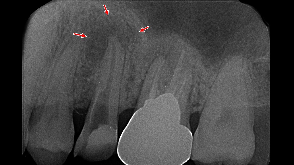 根管治療の不全により生じた根尖病巣（歯根嚢胞）