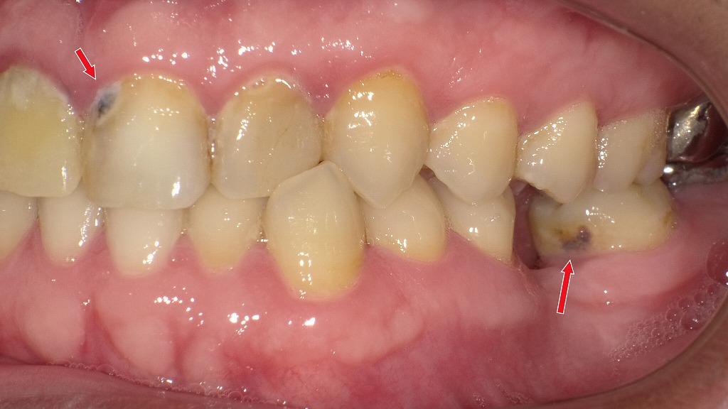 上下にみられる象牙質う蝕(C2)|自然治癒が望めない進行虫歯で治療が必要な状態
