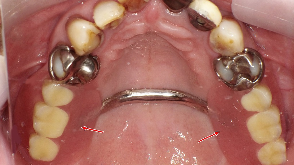抜歯後の選択肢｜保険適用の部分入れ歯