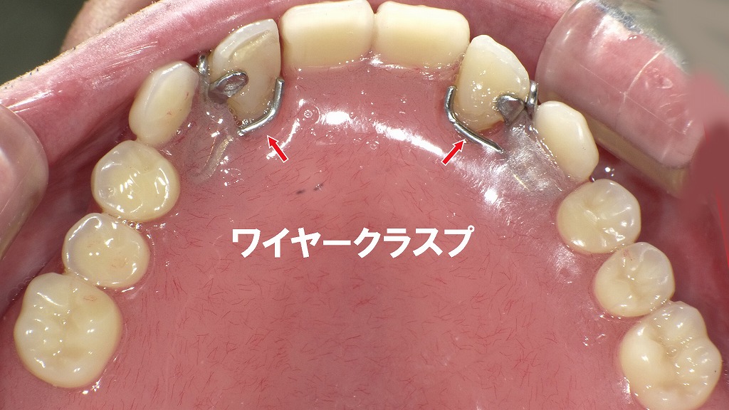 レジン床義歯の上顎咬合面観。左右の歯にワイヤークラスプ(矢印)がかかり、義歯をしっかりと保持・安定させる構造が確認できます。