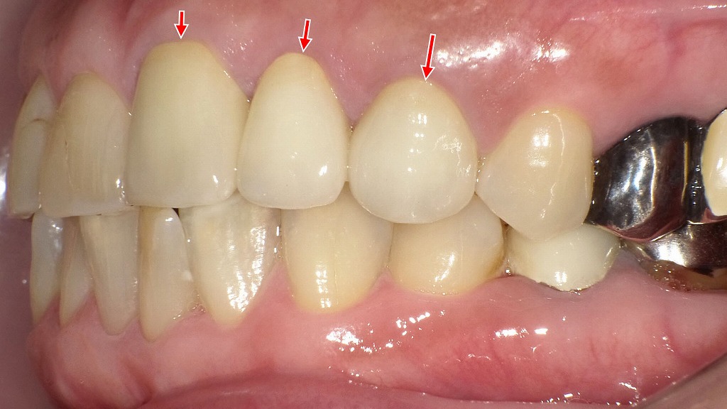 １・２・３番にオールセラミッククラウンを装着した症例