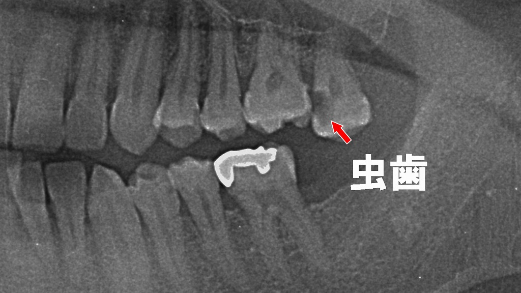 噛み合わせの乱れで生じる段差は要注意!辺縁隆線と虫歯の深い関係