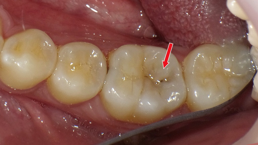 下顎6番の初期虫歯(C1)|咬合面の黒い点、まだ大きな穴は開いていないものの、プラークが停滞しやすい部位のため放置すると象牙質へ急速に進行することがあります。