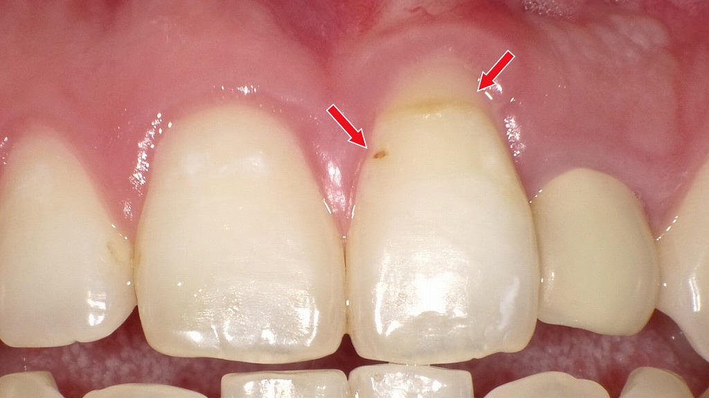歯と歯ぐきの境目(歯頸部)に生じた初期虫歯(C0)です。エナメル質がごく浅く脱灰している削る必要のない虫歯です。