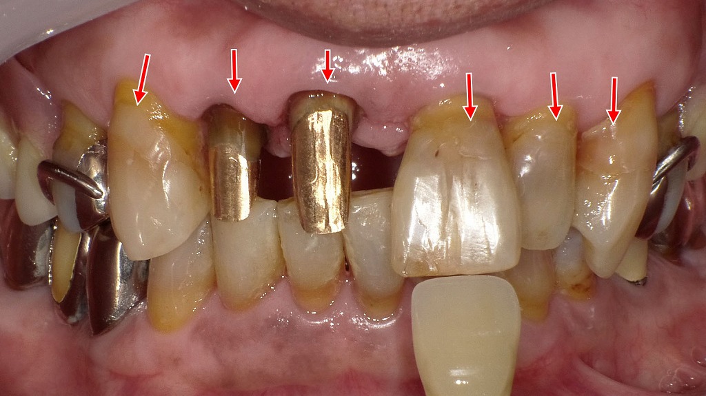 歯頚部う蝕へのレジン修復と前歯部コアの再構築