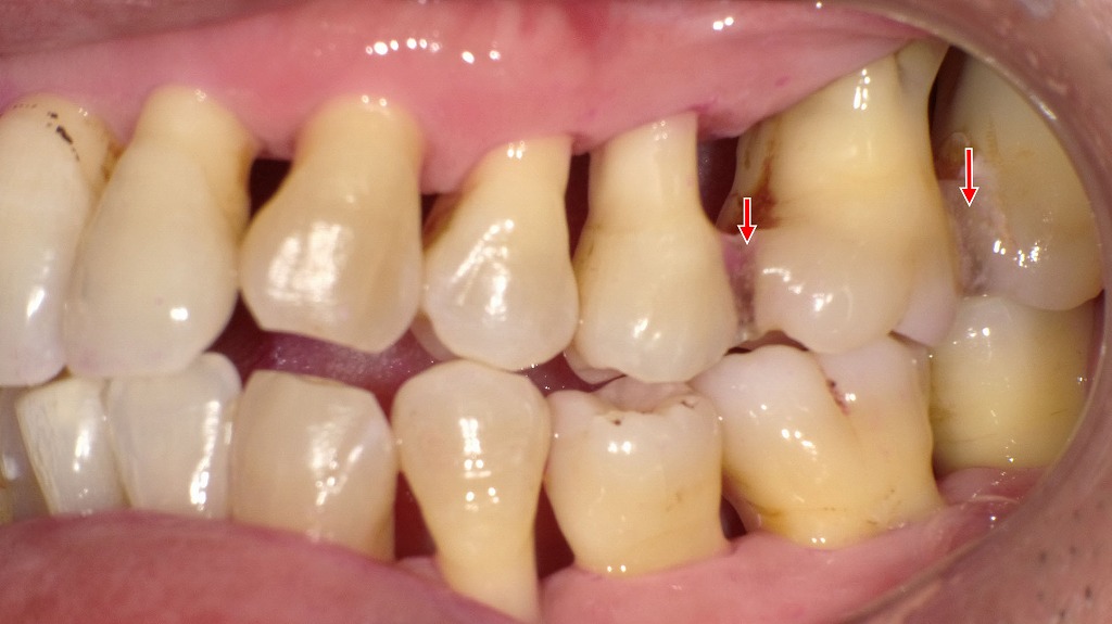 上顎臼歯部に著しい歯肉退縮を認める側面像｜歯周病治療後の変化