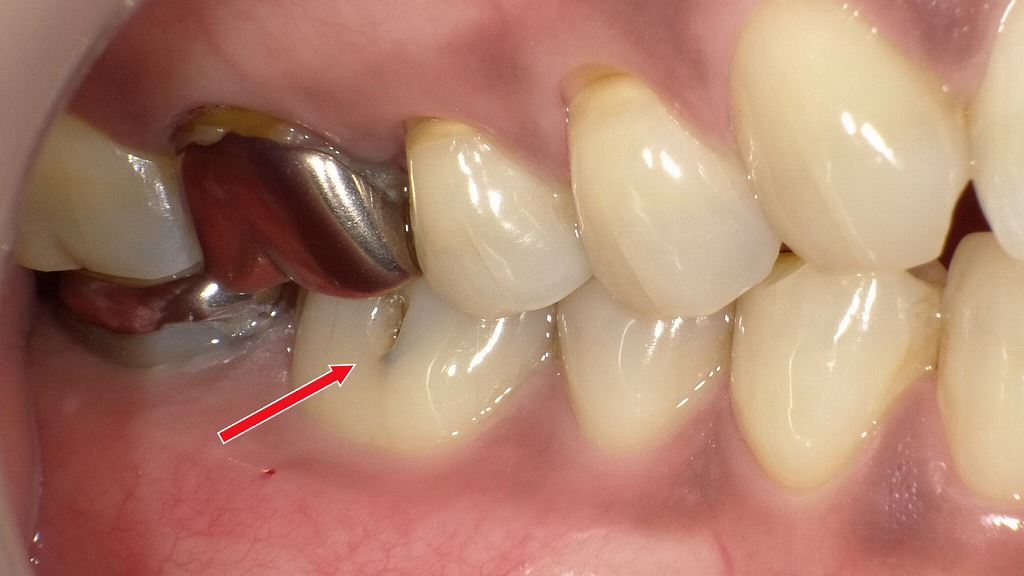 下顎6番・頬側溝から進行した虫歯(C2)|象牙質に達するため治療が必要
