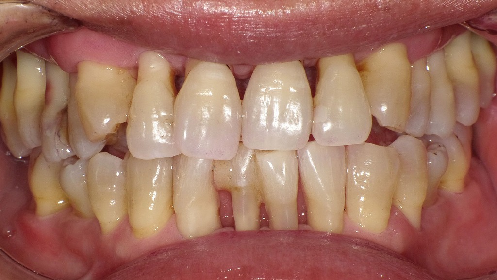 重度歯周病治療後の口腔内所見｜歯肉退縮と良好なプラークコントロール