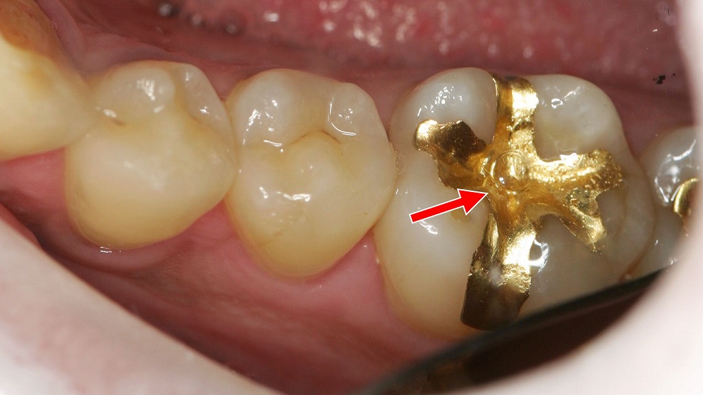 高精度で適合性に優れたゴールドインレー修復