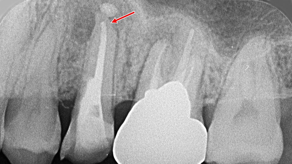 根尖病巣に対する垂直加圧根管充填による再根管治療