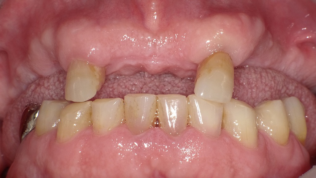 上顎前歯が大きく欠損し、左右の上顎側切歯(2番)のみが残存している状態。義歯装着前のため、咀嚼・発音・審美に影響が出ている口腔内です。
