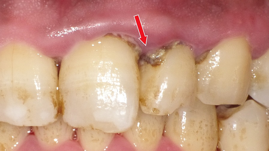 歯と歯ぐきの境目に黒く硬い歯石(縁下歯石)が強く付着しており、その影響で歯の縁が黒く見えています。