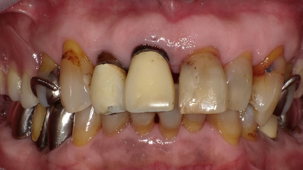 上顎前歯の補綴物周囲にみられる歯頚部トラブルとう蝕