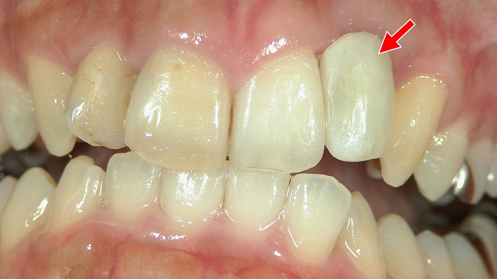 アバットメント交換後の仮歯装着