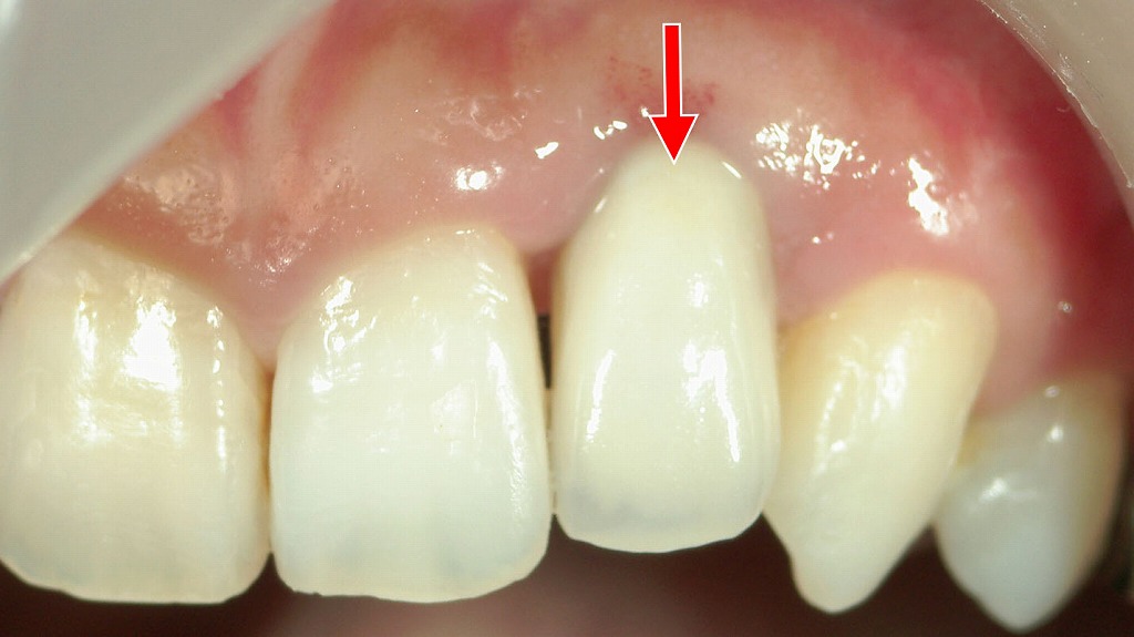 前歯部インプラントへのメタルボンド装着