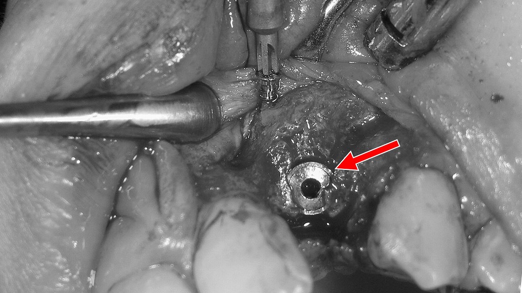 メンブレン除去後のインプラント露出