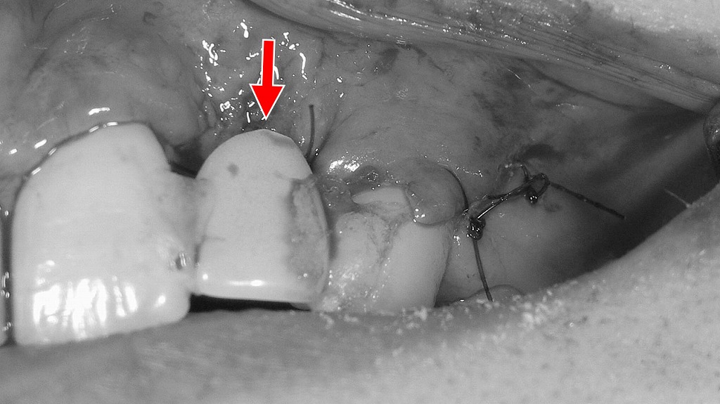 縫合後の創部安定と仮歯の固定