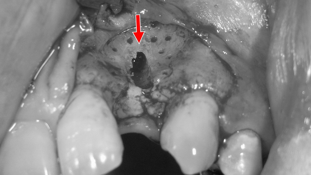 上顎2番欠損部へのインプラントドリリング