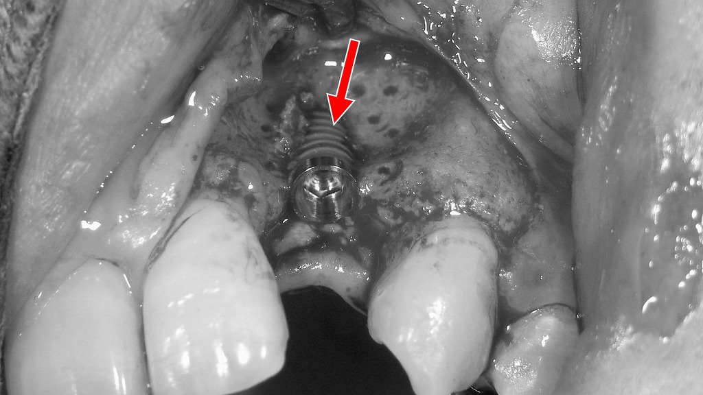 上顎2番部インプラント埋入時の骨不足とスクリュー露出