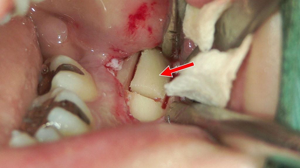 下顎臼歯部頬側からの自家骨採取