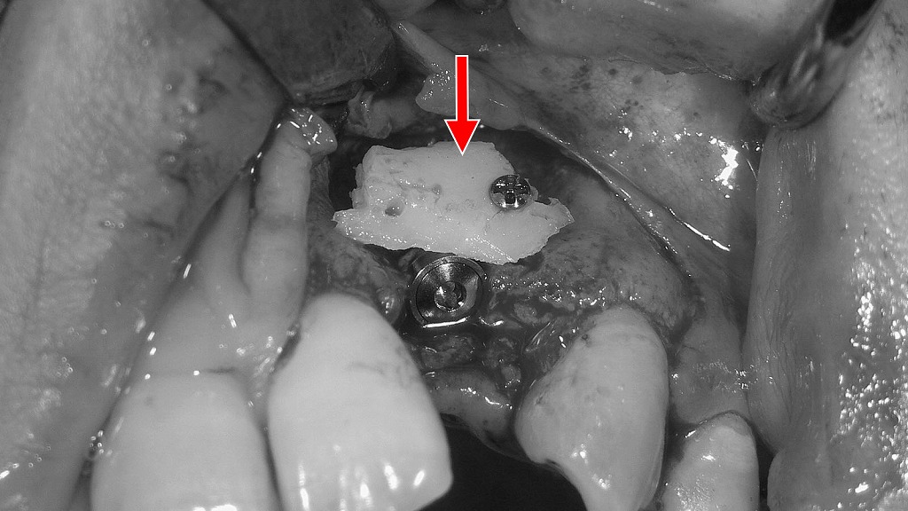 スクリュー露出部への自家骨移植と固定