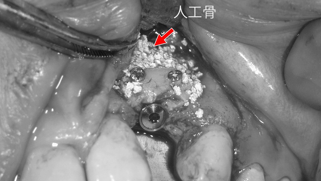 骨造成スペースへの人工骨填入