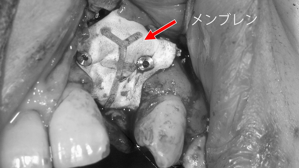 非吸収性メンブレンによる骨造成部の被覆