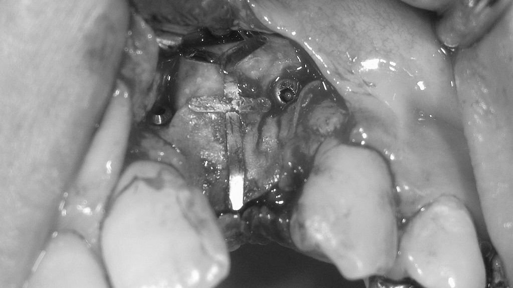 二次手術時に認められたメンブレン露出